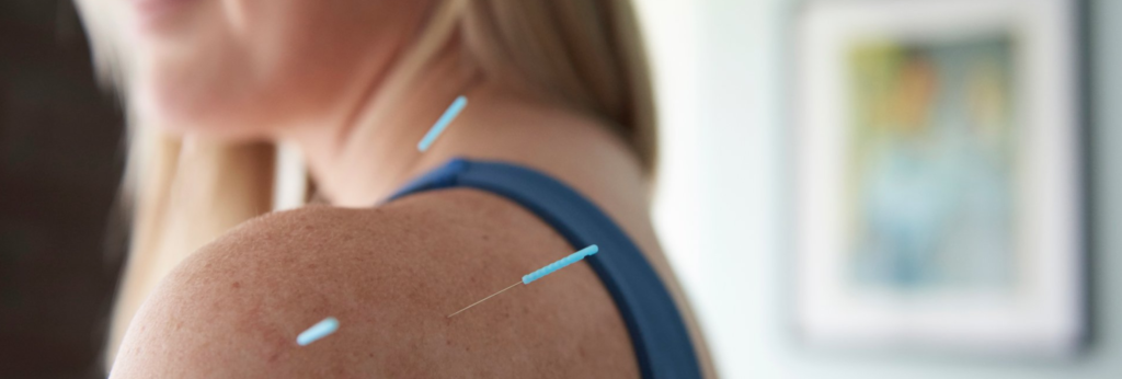 Woman's shoulder with three acupuncture needles sticking in it